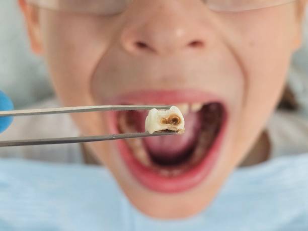 Best Emergency Tooth Extraction in Hallsville, TX